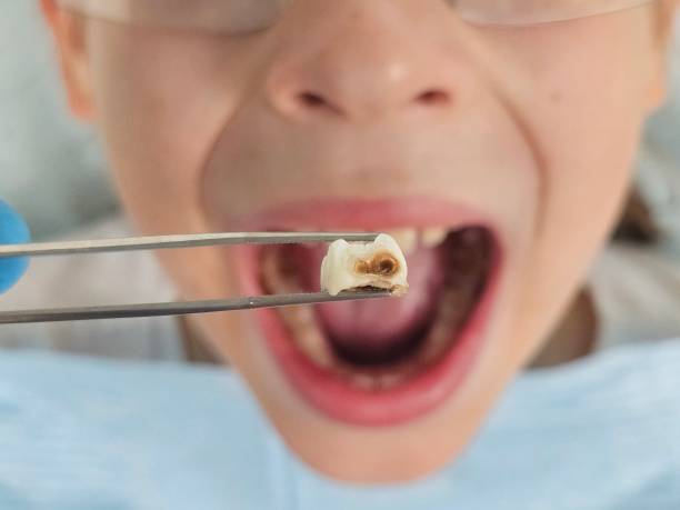 Best Urgent Care for Lost Fillings or Crowns in South Dennis, NJ