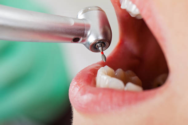 Best Emergency Dental Care for Broken or Chipped Teeth in South Dennis, NJ